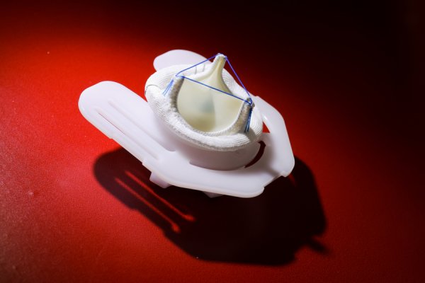 证配所配资 最新干式二尖瓣瓣膜在中国上市，20余家瓣膜中心完成首批植入